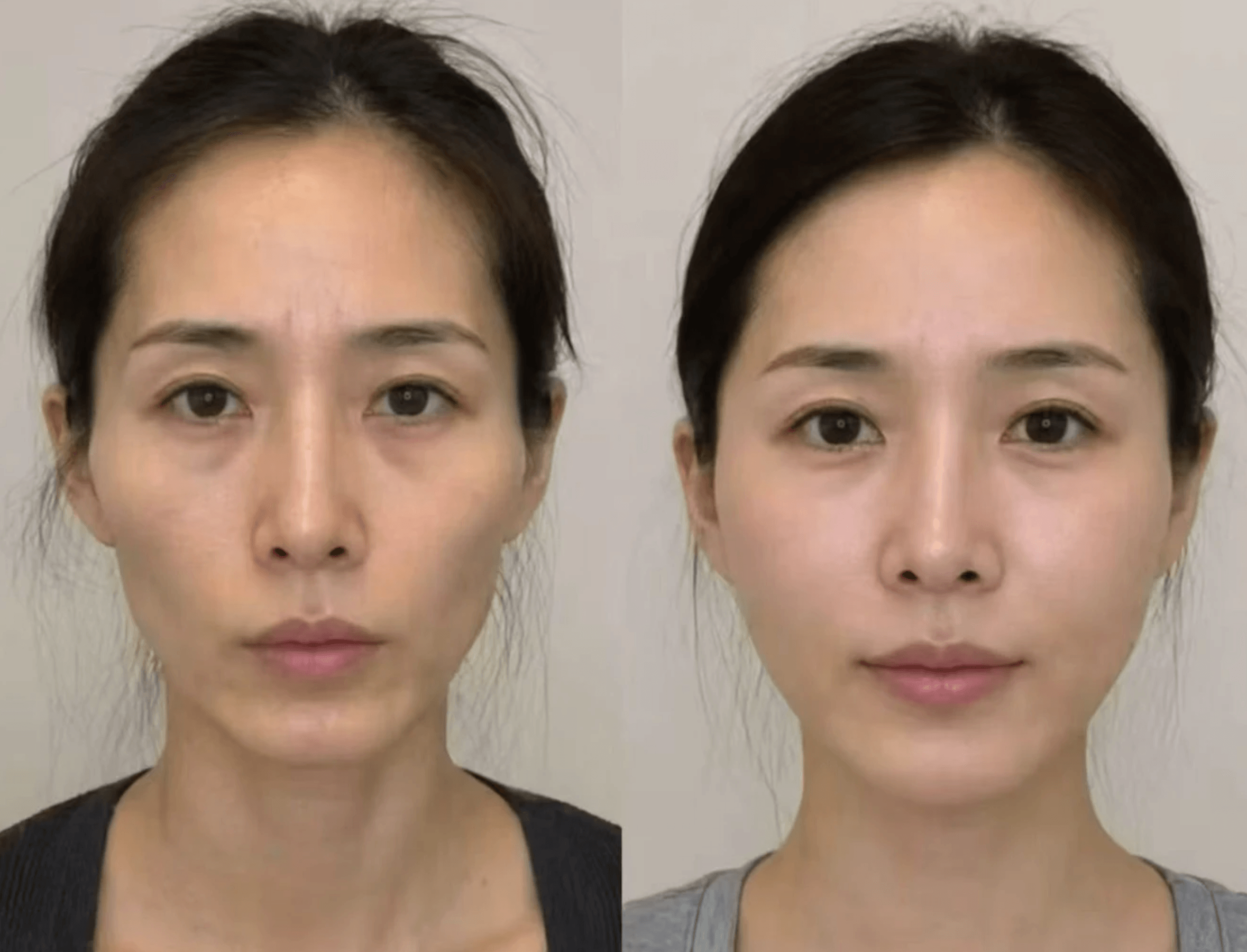 Before and after result from a Velora Aesthetics client