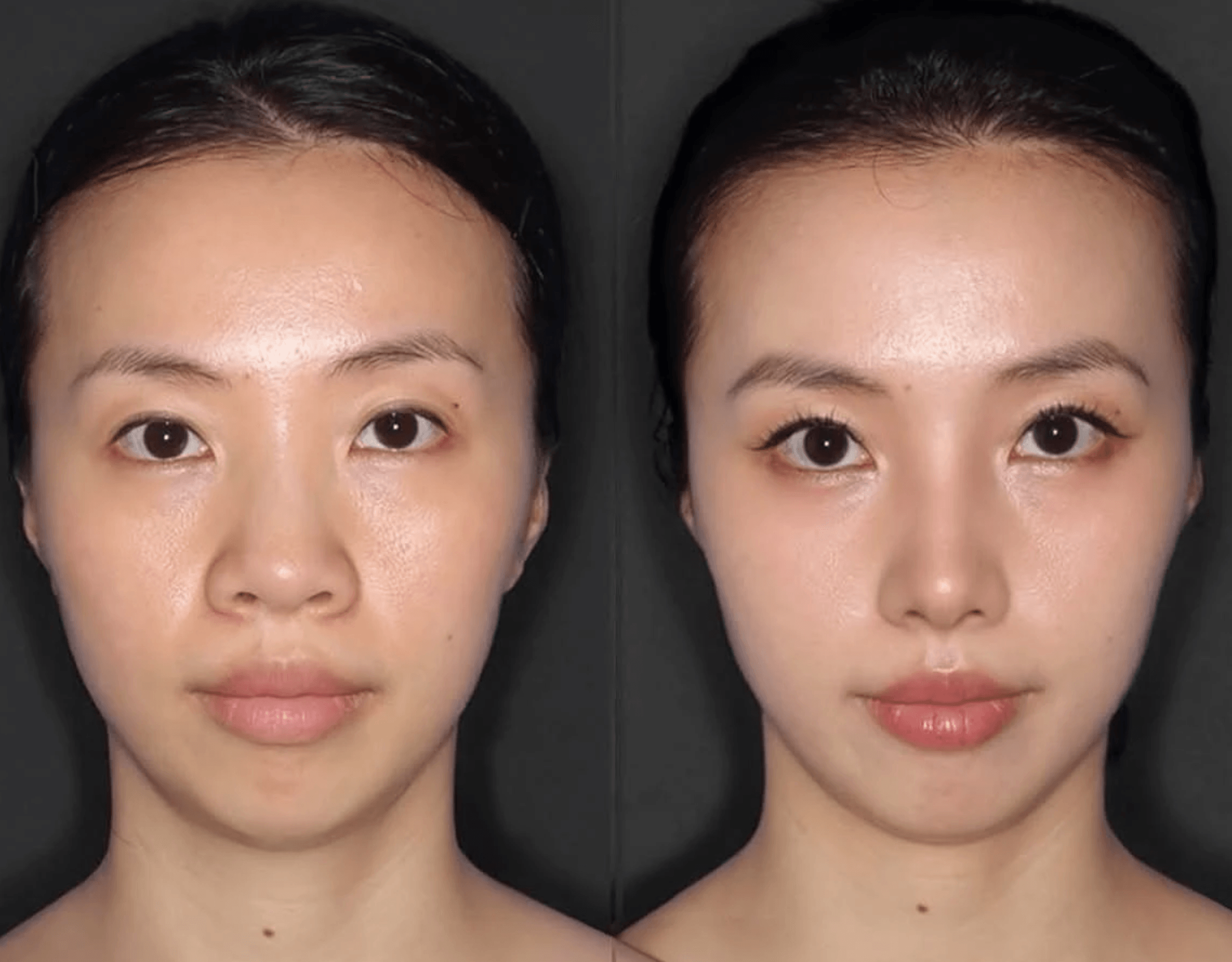 Before and after result from a Velora Aesthetics client