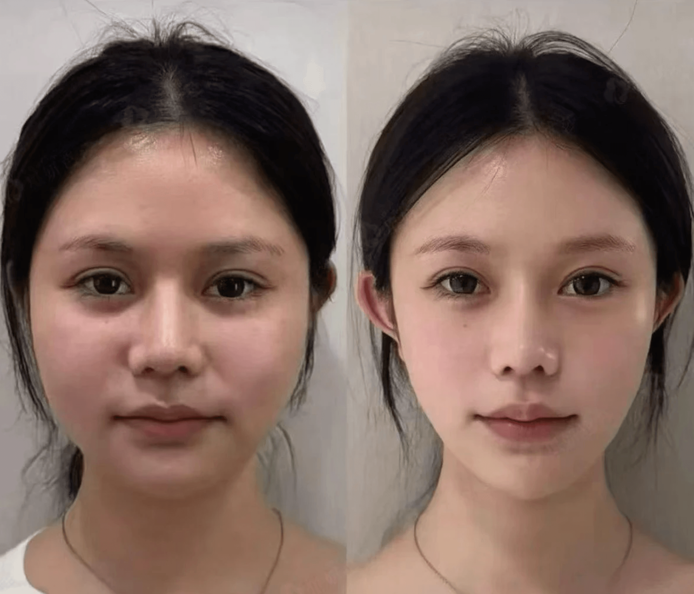 Before and after result from a Velora Aesthetics client